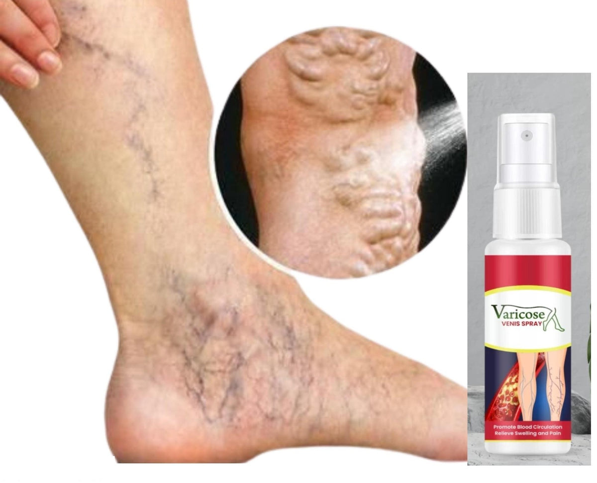 Varcose Venis Spray (Pack of 2)
